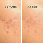 Rael Pimple Patches, Miracle Spot Control Cover - Hydrocolloid Acne Pimple Patch, Strips for Zits and Blemish, Korean Skin Care (20 Count)